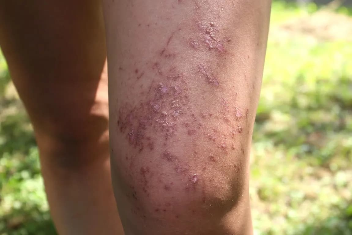 Mały barszcz sosnowskiego: Jak wyglądają poparzenia?